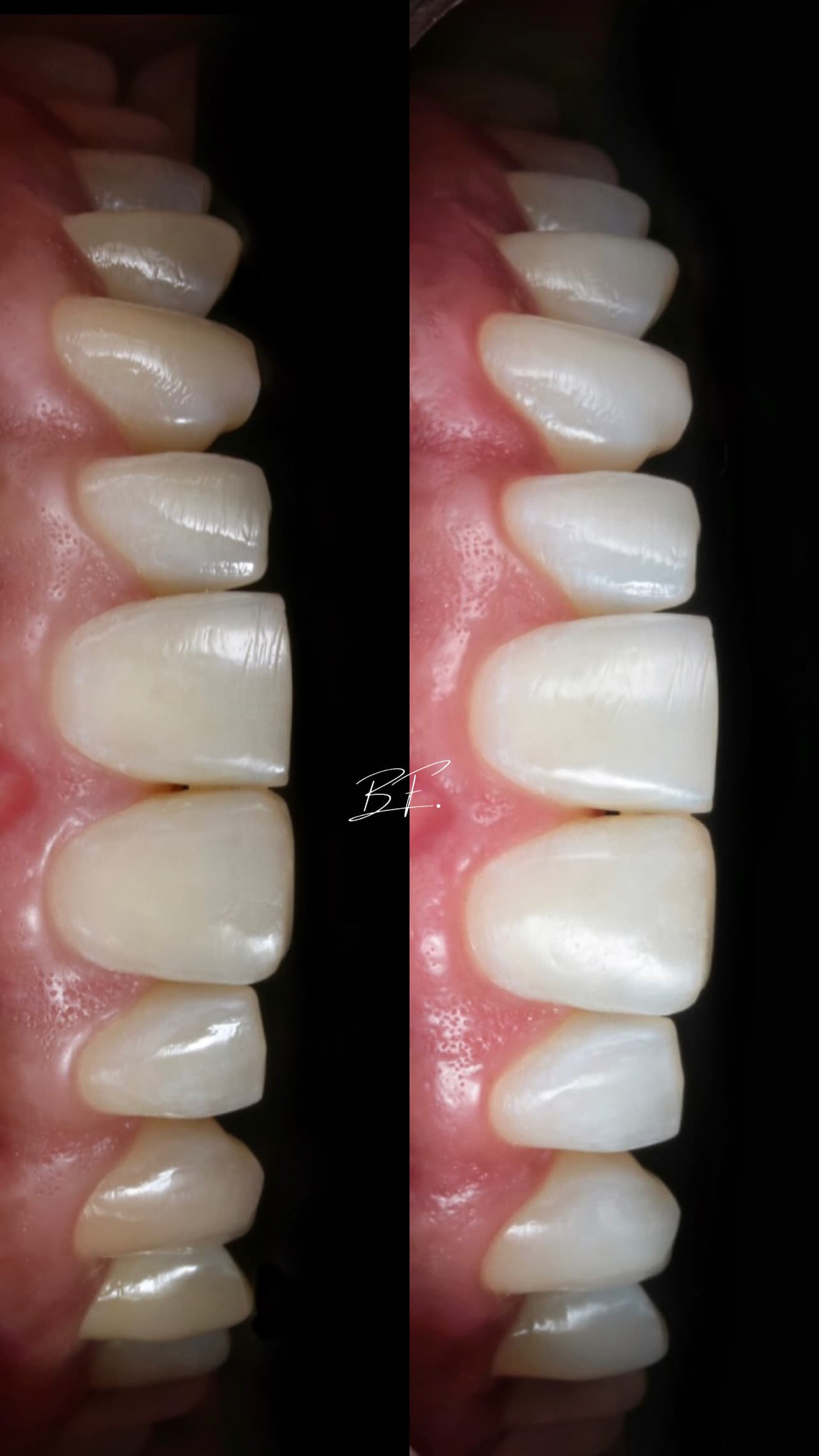 Clareamento Dental Premium - Foto 2