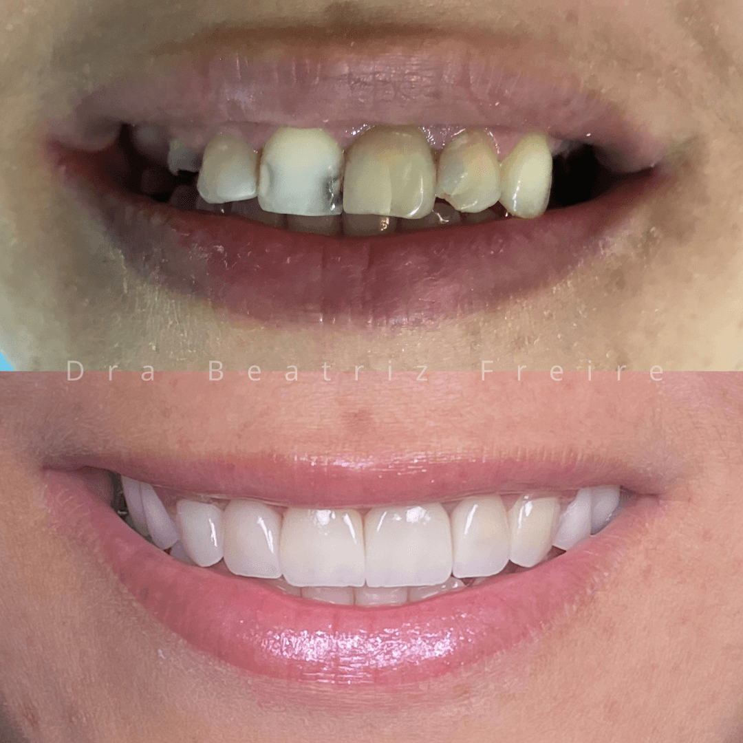 Lentes de Contato Dental