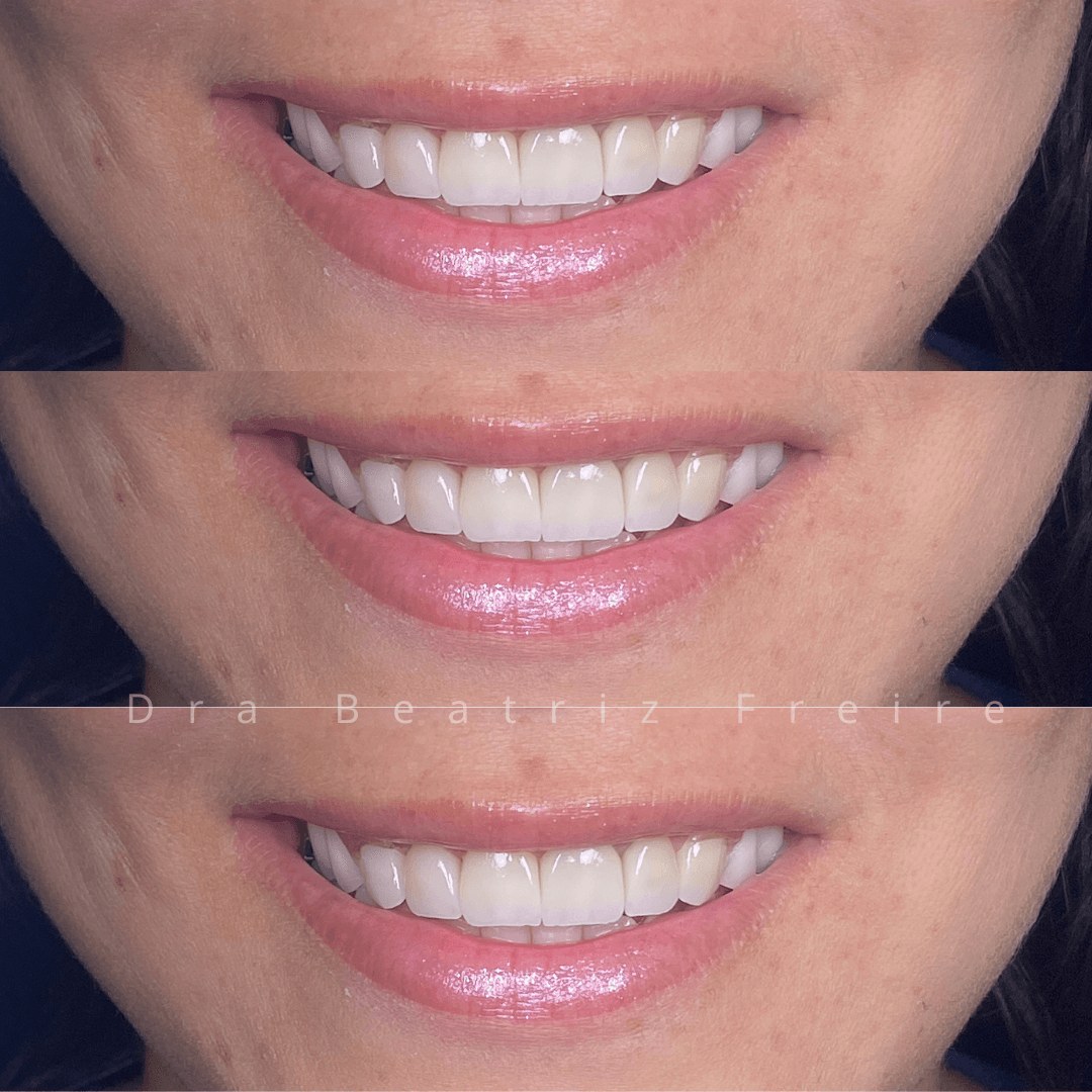 Lentes de Contato Dental - Foto 2