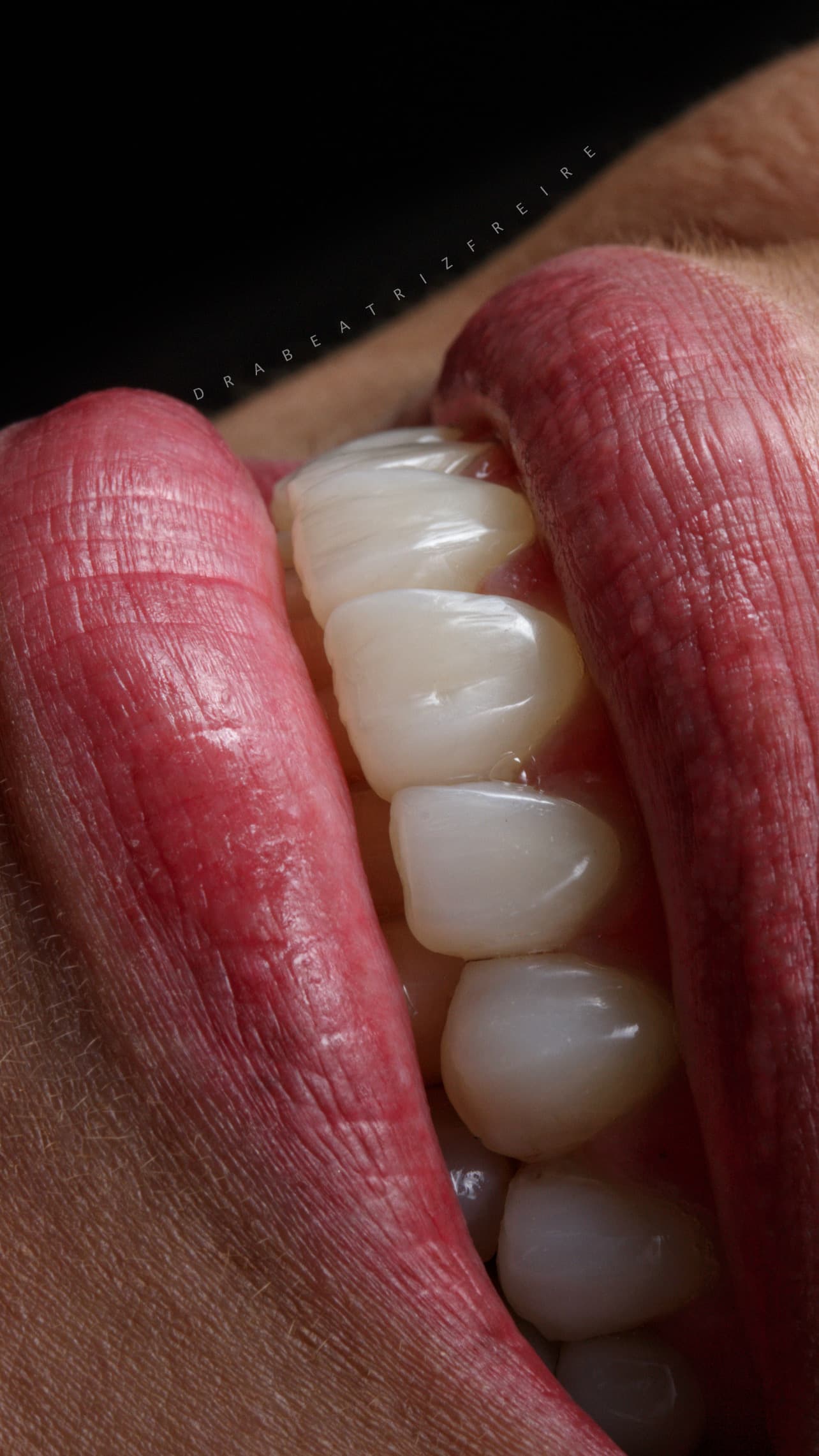 Transformação em Resina