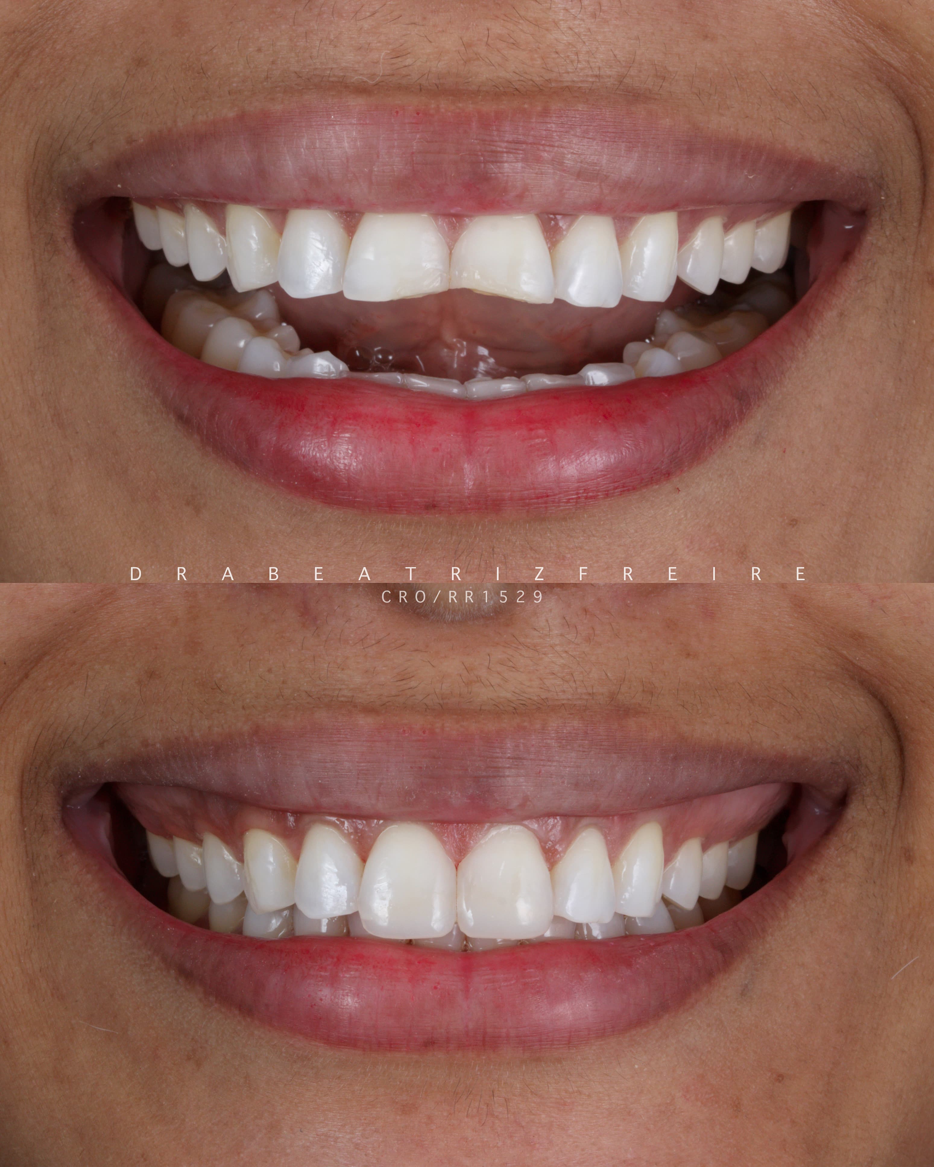 Transformação em Resina - Foto 3