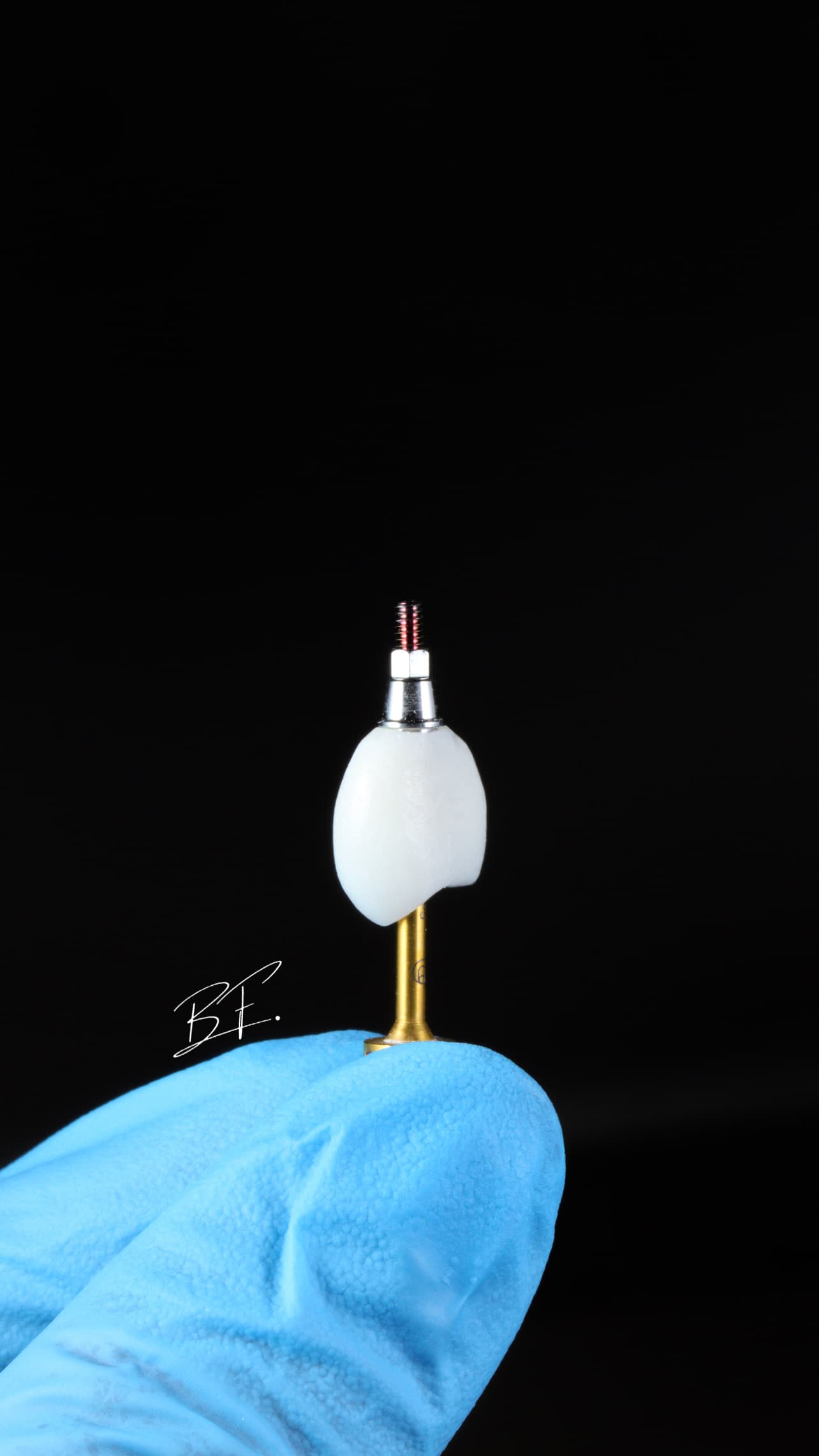 Implante Unitário Estético