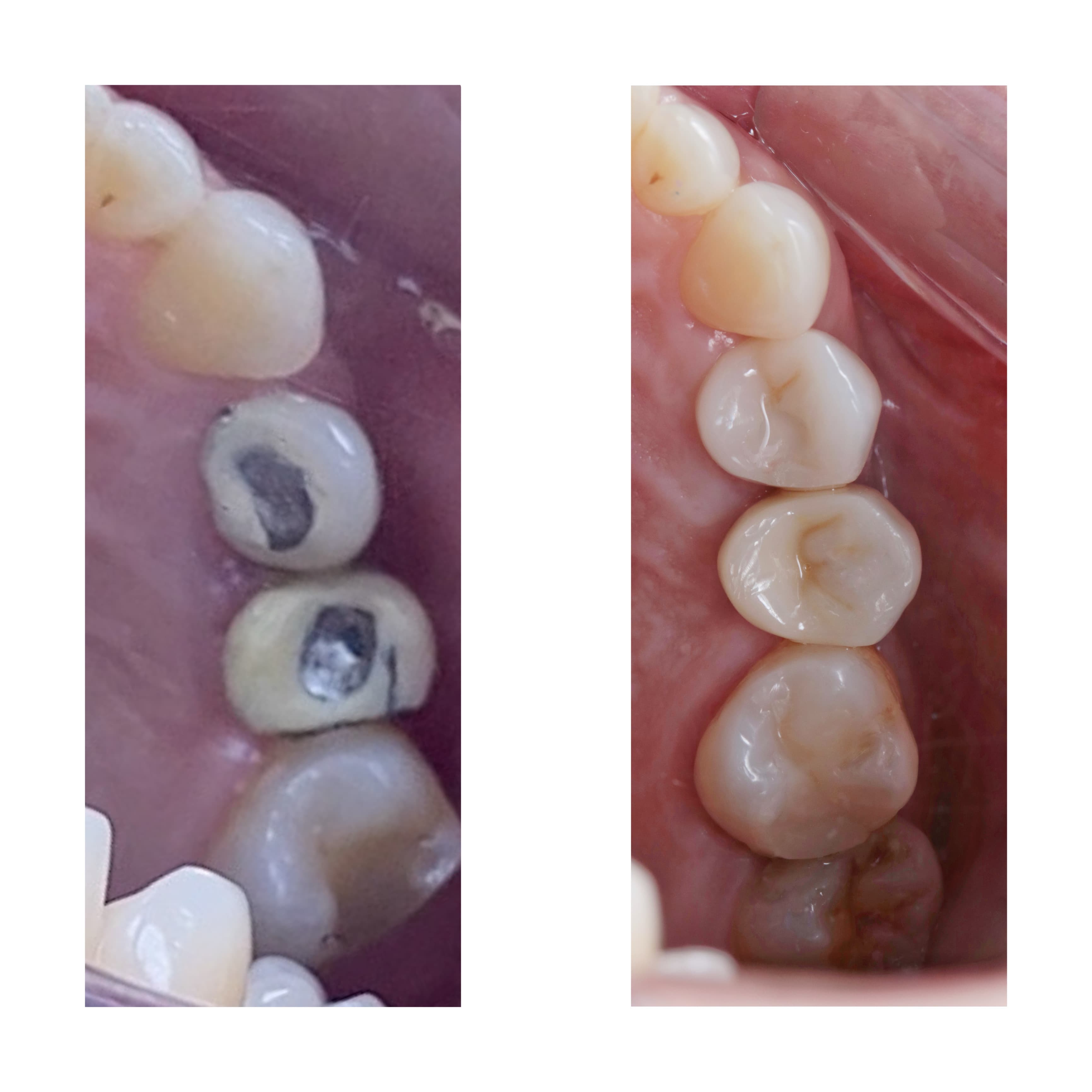 Implante Unitário Estético - Foto 2