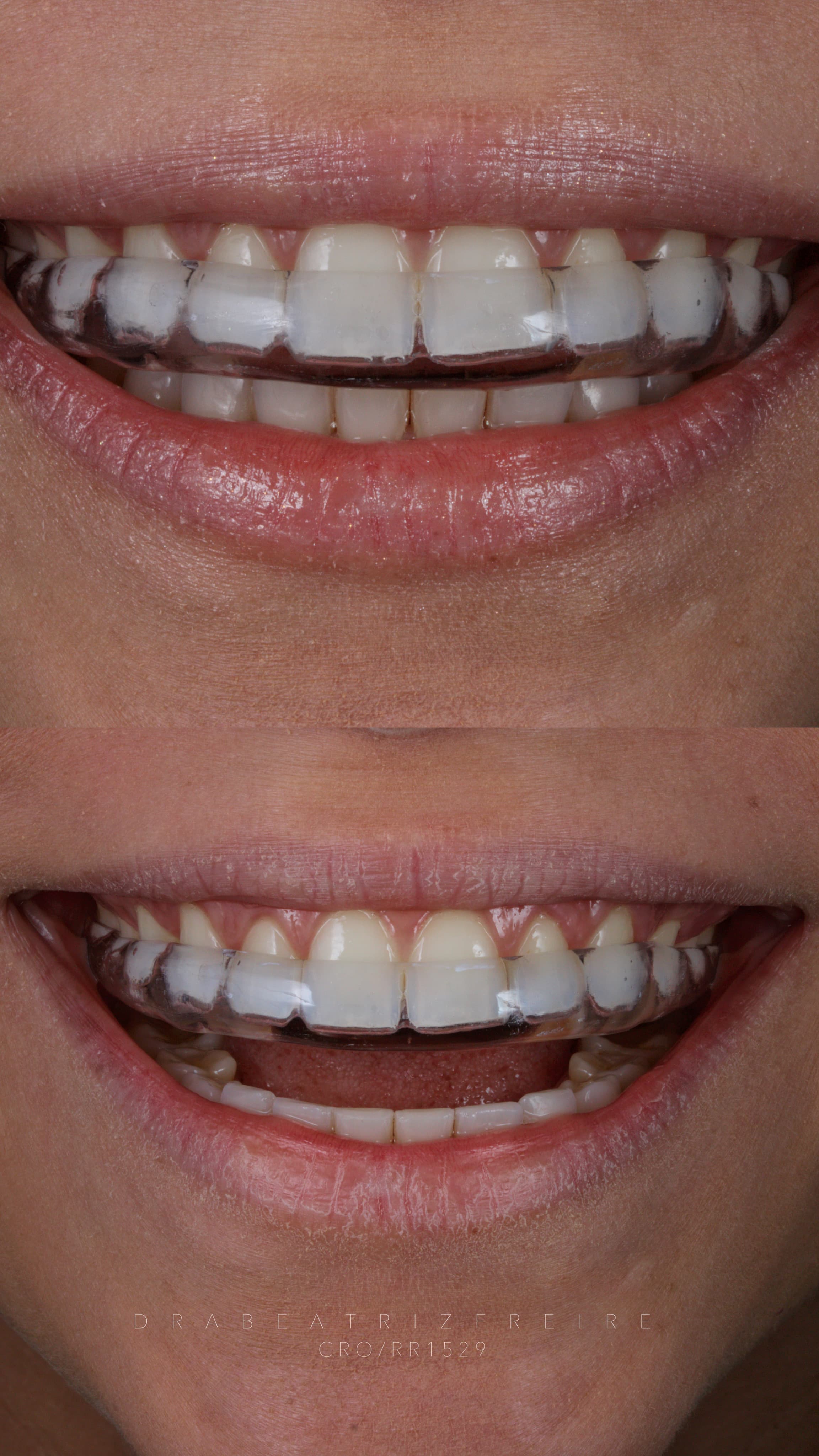 Controle do Bruxismo